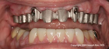 The real price of dental tourism, in plain numbers.