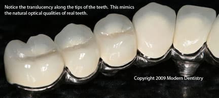 Why 4 implants isn't always enough — and when it is.