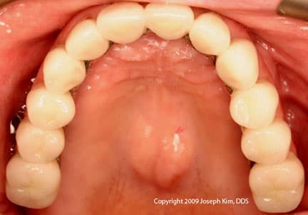 Terminal Bite · Occlusal — after