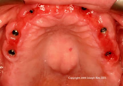Terminal Bite · Occlusal — before