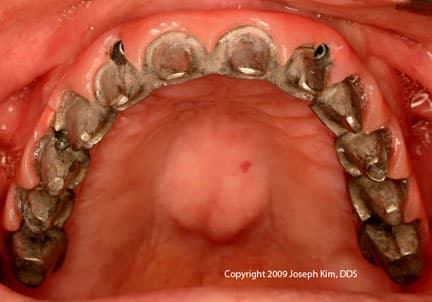 A week-by-week guide to healing after implant surgery.